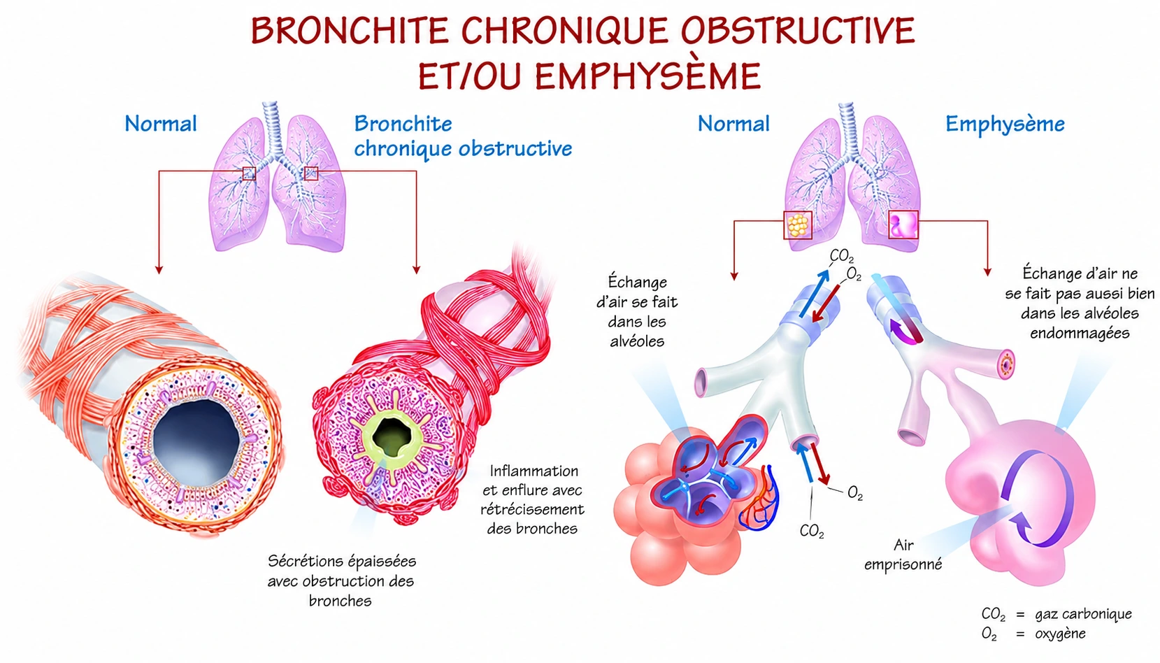 Emphysème et inflammation des bronches