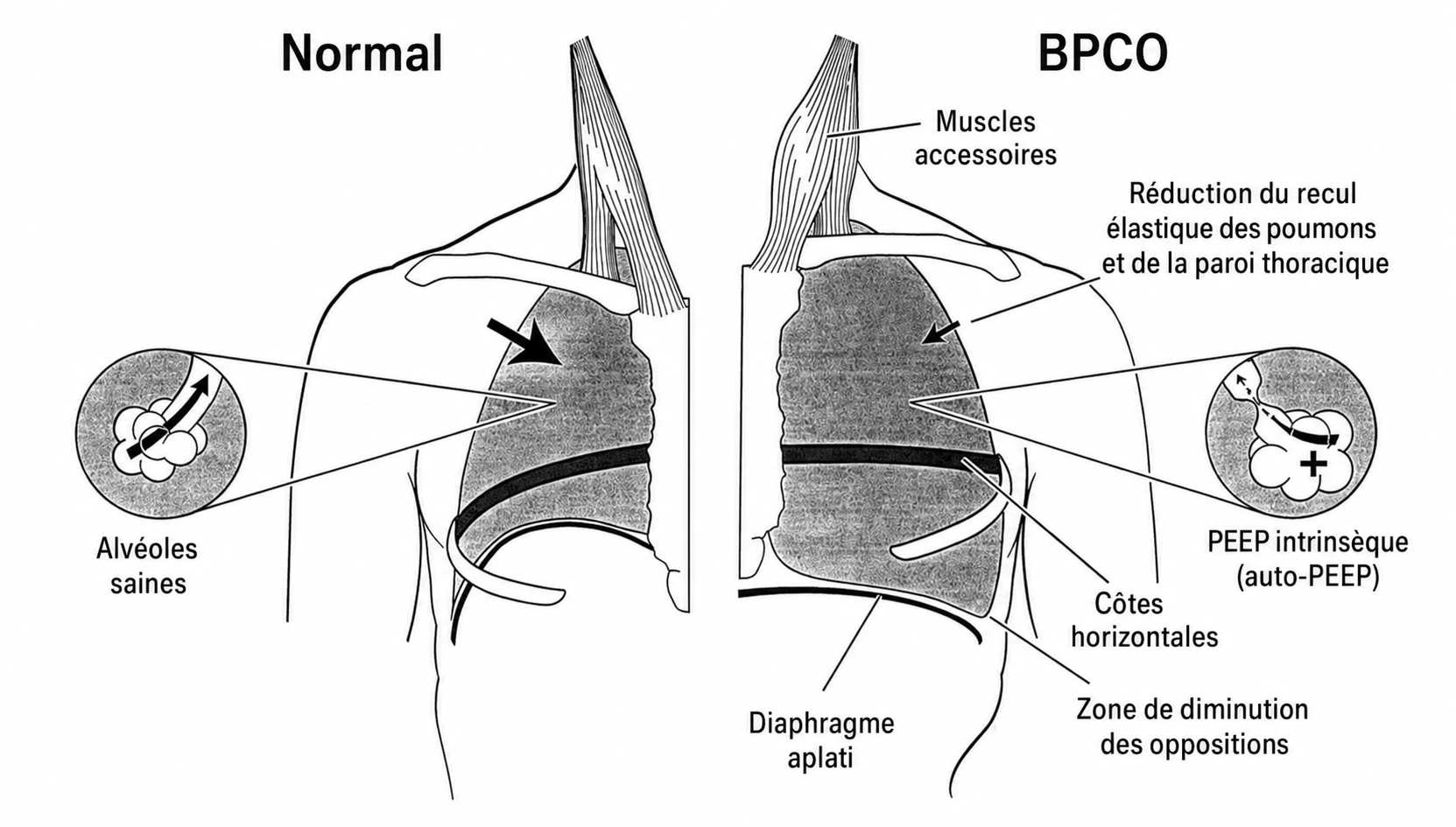 position diaphragme normal vs BPCO